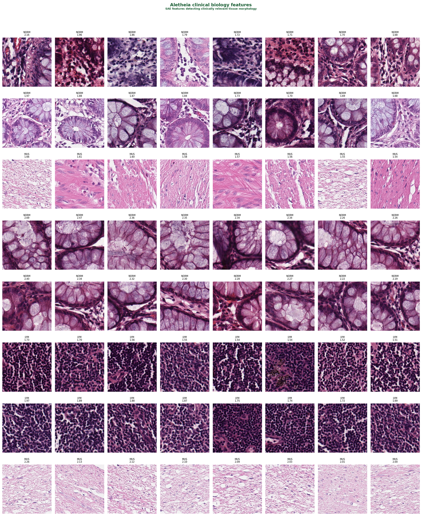 Clinical biology features — top-activating patches for SAE features linked to tissue morphology